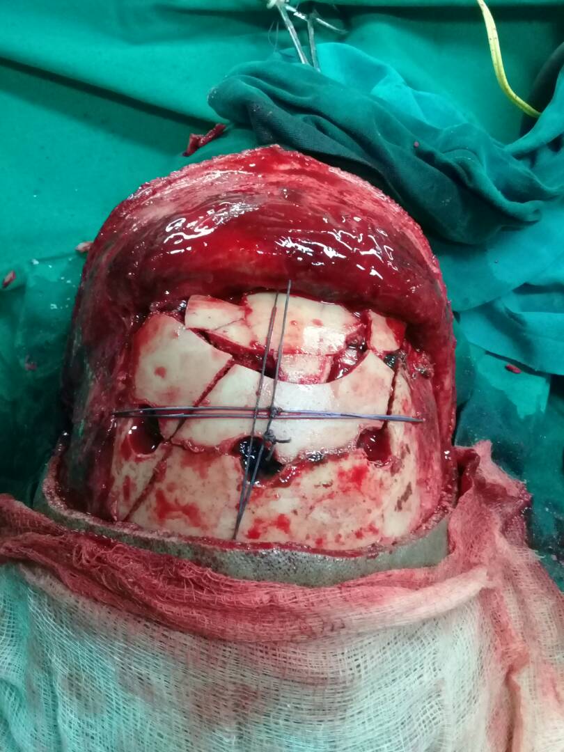 trauma craniotomy case managed with limited resources 